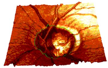 3D Darstellung der Papillenoberflöche