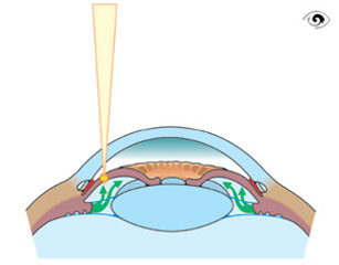 Laseriridotomie