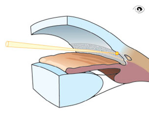 Trabekuloplastik mit einem Argonlaser